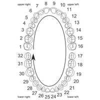 T Bar Gap